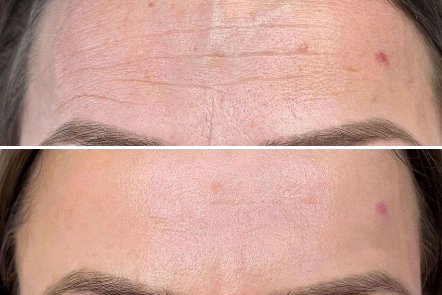 Tecnico PhiIon - Svitlana Bidzilia esegue un trattamento di Microneedling. Tecnico PhiIon - Svitlana Bidzilia esegue un trattamento di Microneedling.